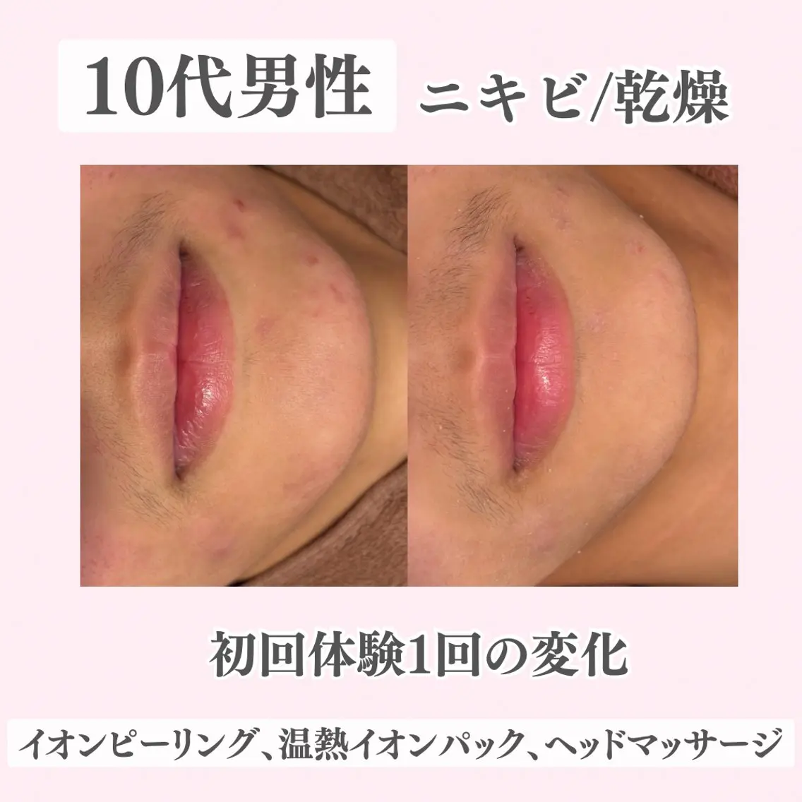 エステ リラク ニキビ・肌質改善専門 ♡人生が変わるサロンのエステ・リラクイメージ