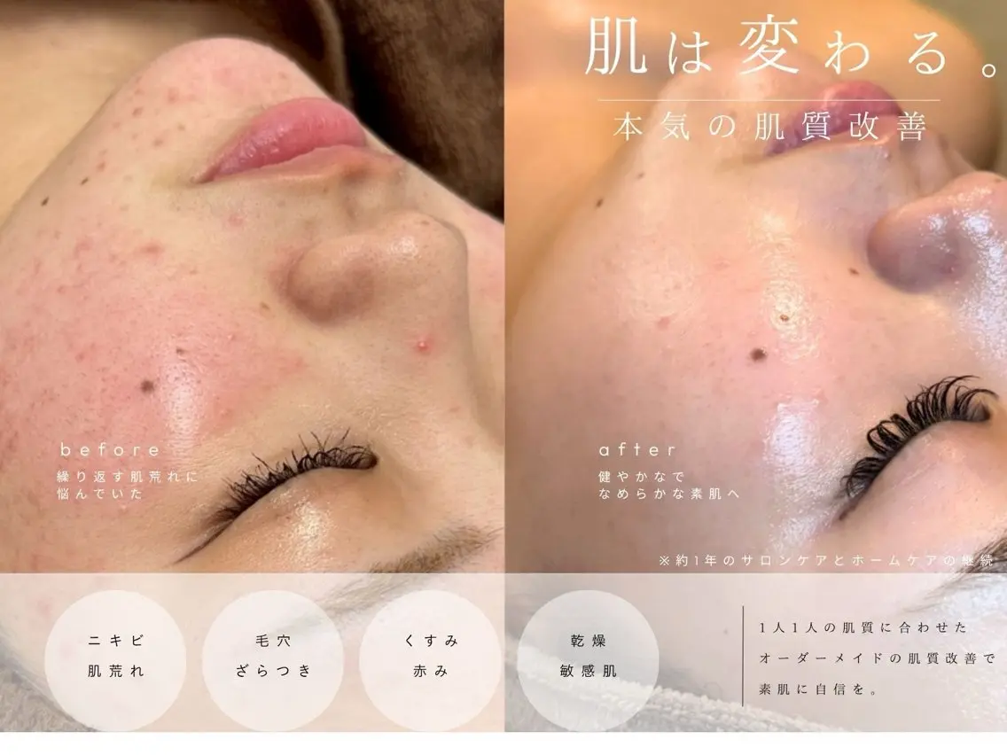 肌質改善| Rootree Miのエステ・リラクイメージ
