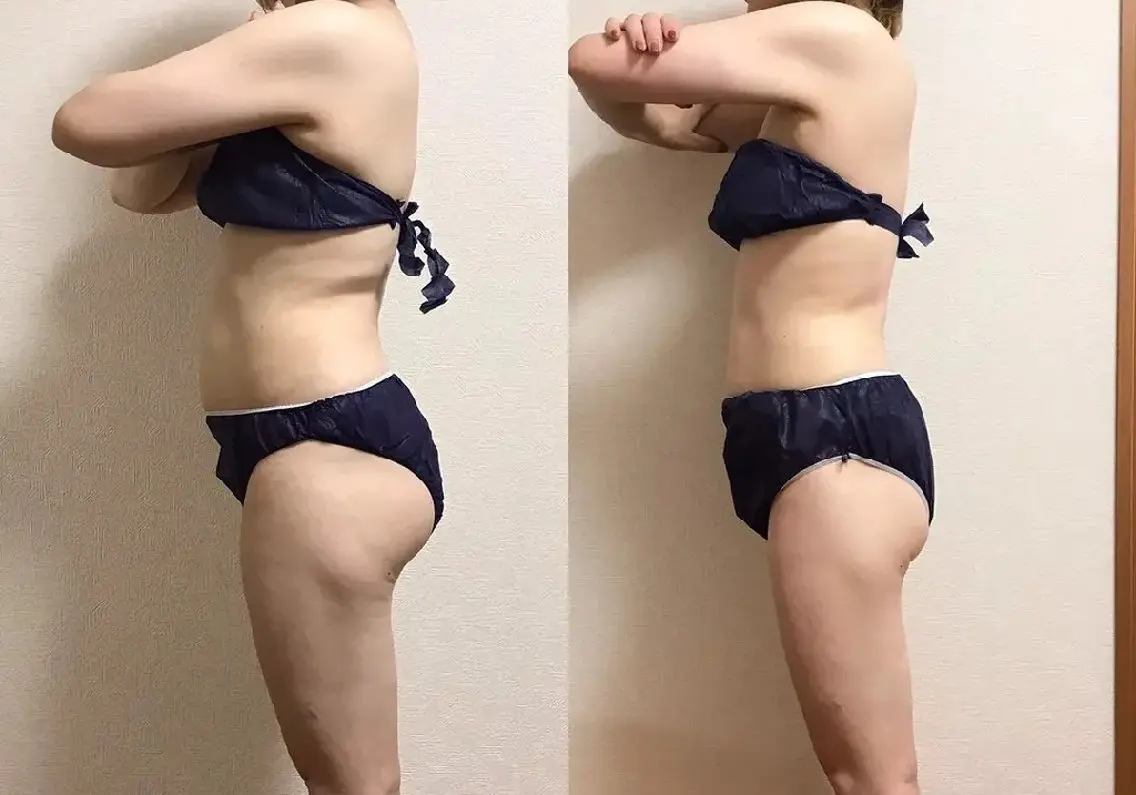 肉取り　ボディエステの写真