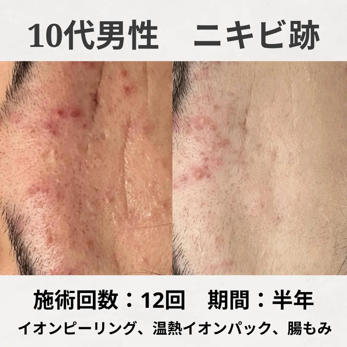 エステ リラク 何をしても繰り返す ニキビ・ニキビ跡専門のエステ・リラクイメージ