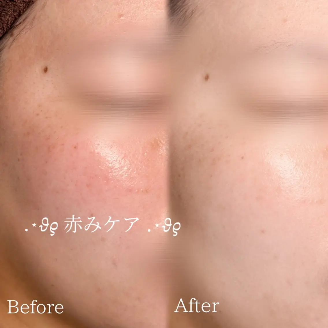 定期肌管理 | 鎮静ケアコース🫶🏻の写真