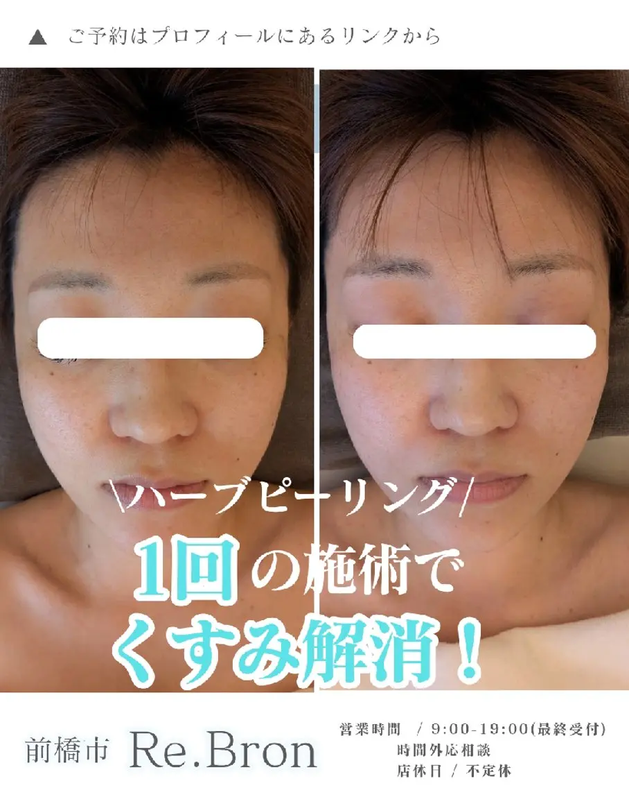たるみ・ くすみ シミ・ニキビ肌改善のエステ・リラクイメージ