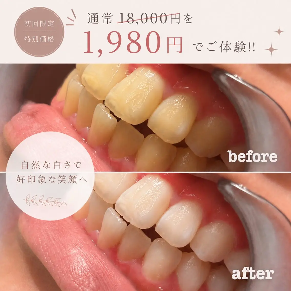 【新メニュー導入キャンペーン🦷✨】セルフホワイトニング(20分照射)※口コミ必須の写真