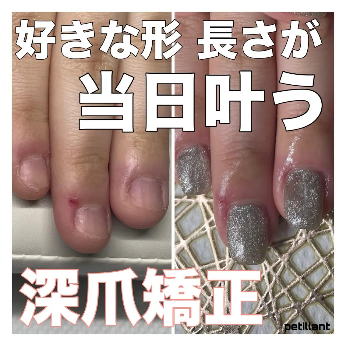 深爪矯正【長さ出し】◆ﾗﾒ/ｸﾞﾗﾃﾞｰｼｮﾝ◆(オフ込)むしったり 割れたり 噛んで小さくなった爪も綺麗な状態に✧︎の写真