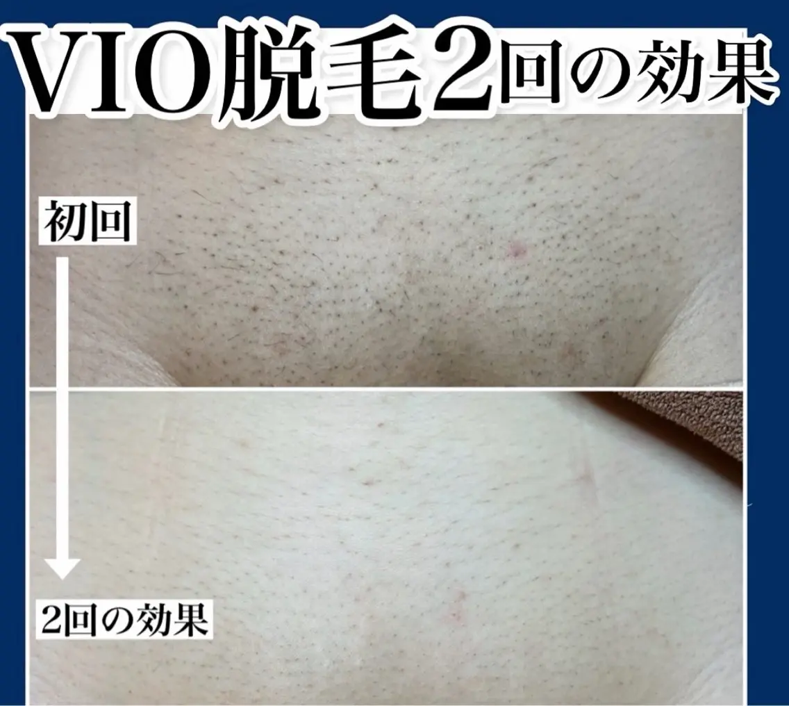 VIO脱毛の写真