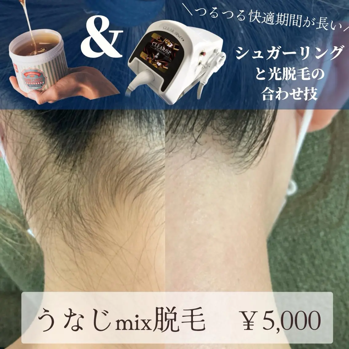 後ろ姿美人✨うなじシュガーリング×最新式光脱毛の合わせ技!mix脱毛でつるつる長持ち👶💓デザイン込みの写真