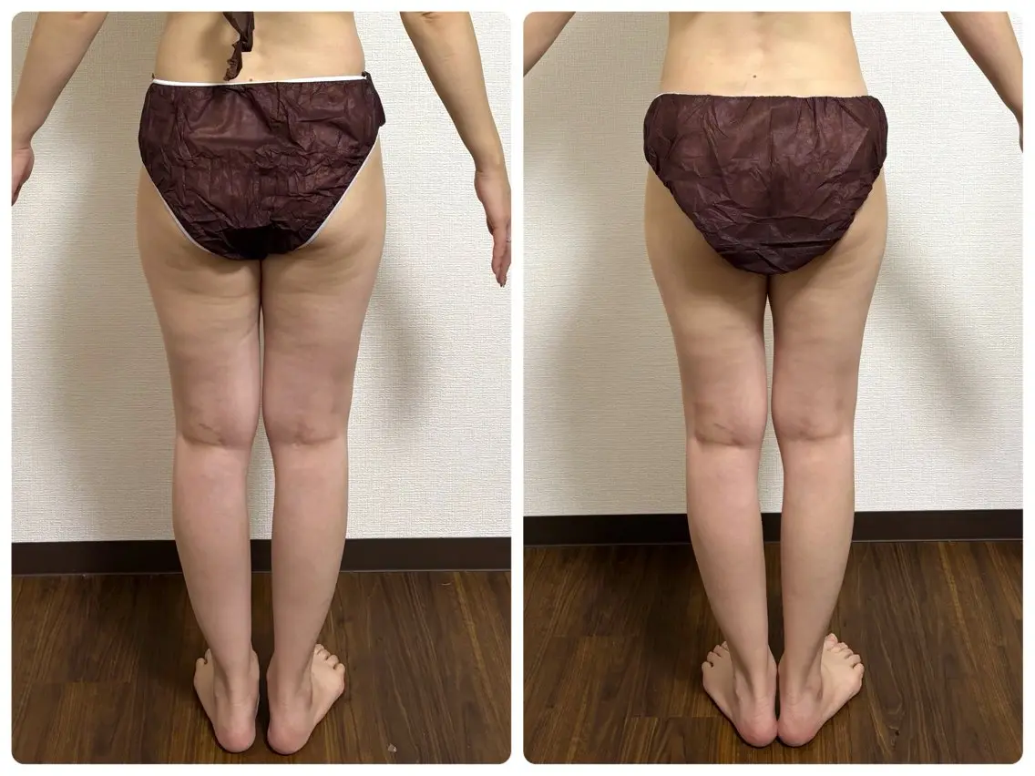 ミニモ限定✨夏に向けて足痩せしたい方のウィンバック足痩せ3回コース✨セルライトが気になる方‼️お気に入り登録者限定♪の写真