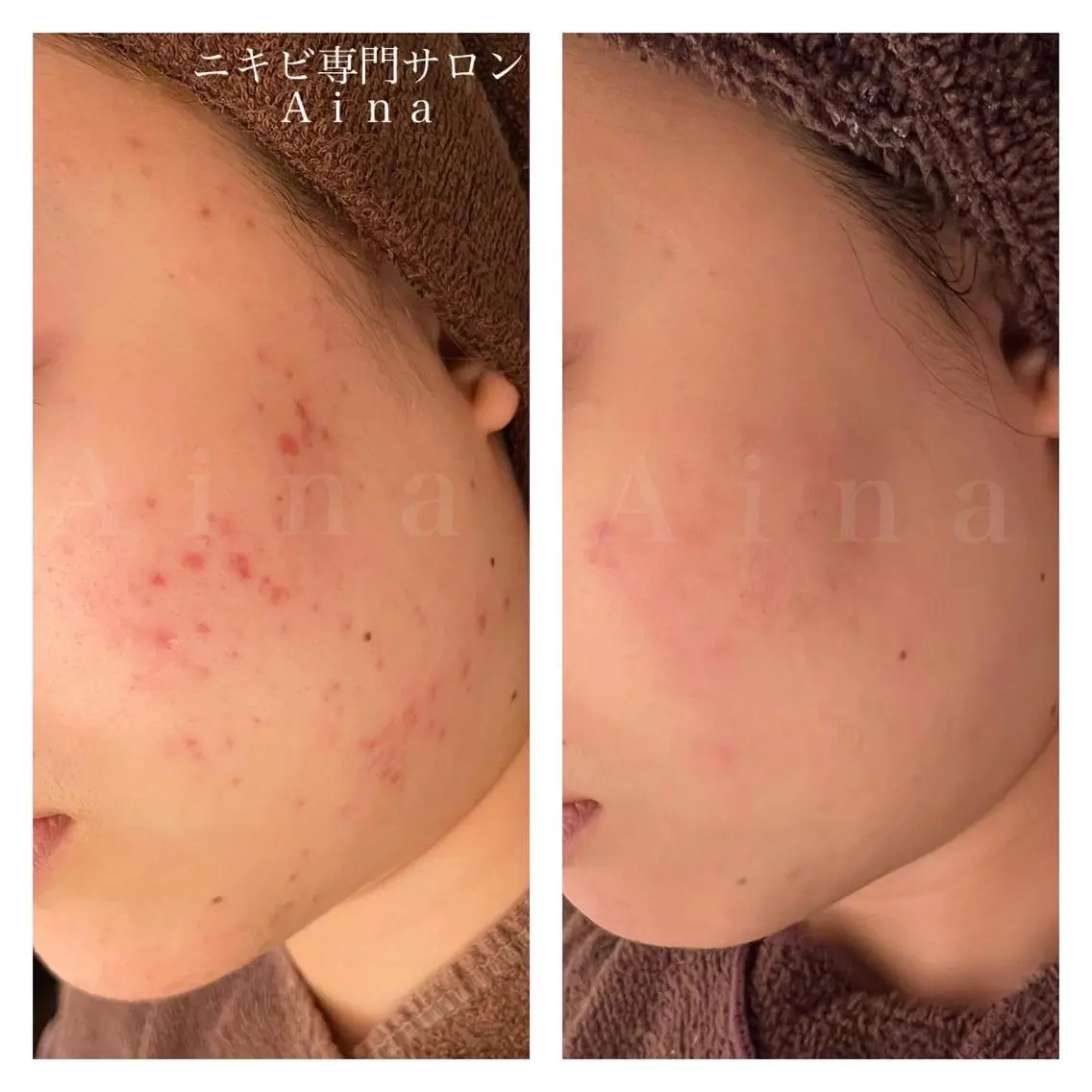 ミディアム パーマ ヘアアレンジ メンズ キッズ ネイル マツエク・マツパ アイブロウ 赤色 エステ リラク ニキビ跡専門サロン Ainaのエステ・リラクイメージ