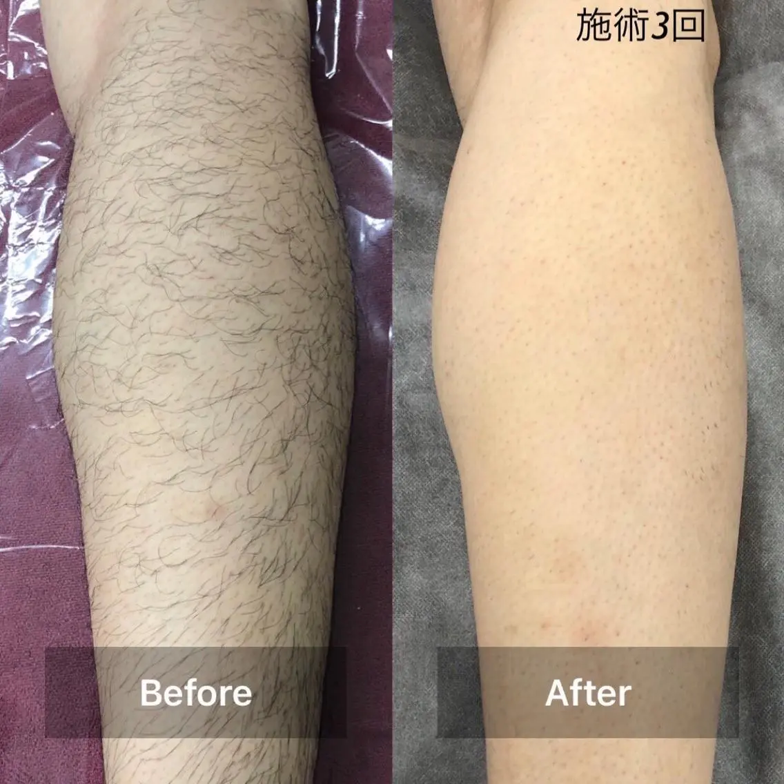 【メンズ】足セット脱毛(ひざ・足の甲・ひざ上・ひざ下) ♪保湿ケア付♪の写真