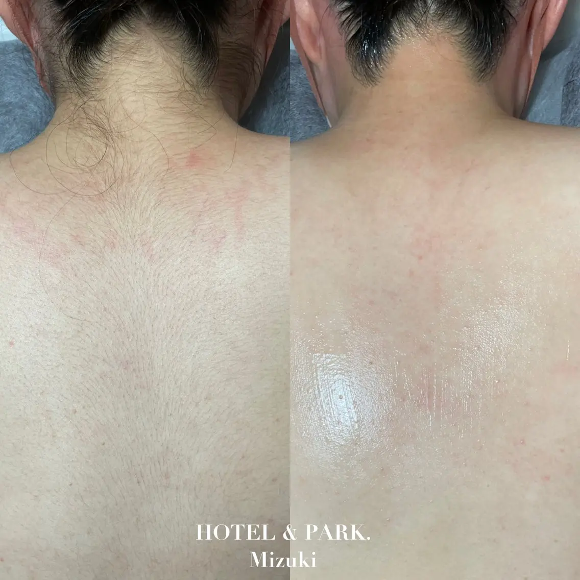 HOTEL&PARK . ワックス脱毛のエステ・リラクイメージ