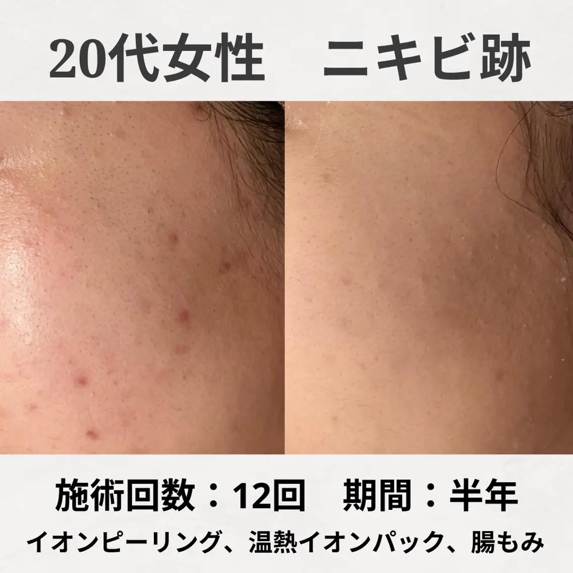 エステ リラク ニキビ跡改善専門🔥 医療にはできない改善のエステ・リラクイメージ