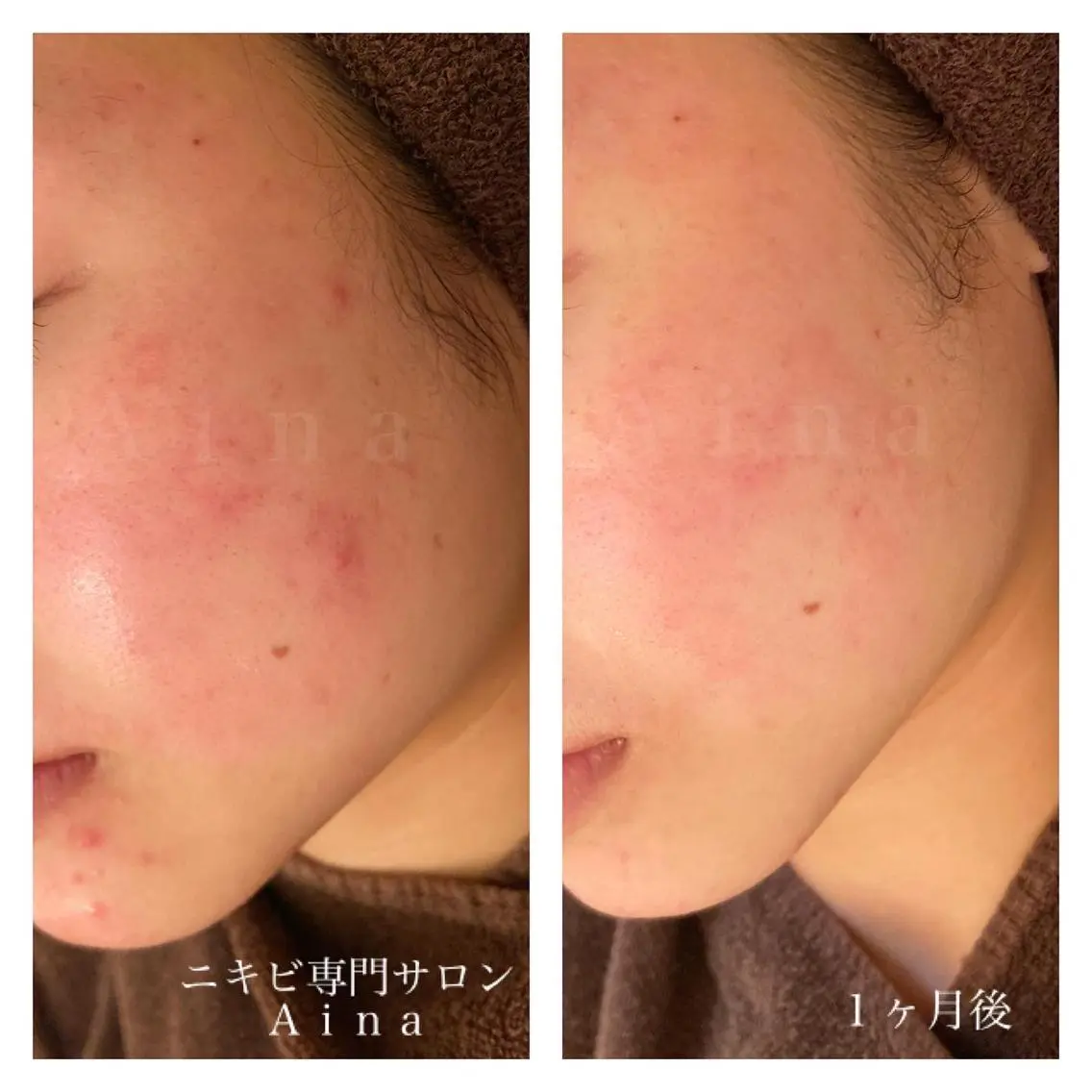 ミディアム カラー パーマ ヘアアレンジ メンズ キッズ ネイル マツエク・マツパ 赤色 ニキビ跡専門サロン Ainaのエステ・リラクイメージ