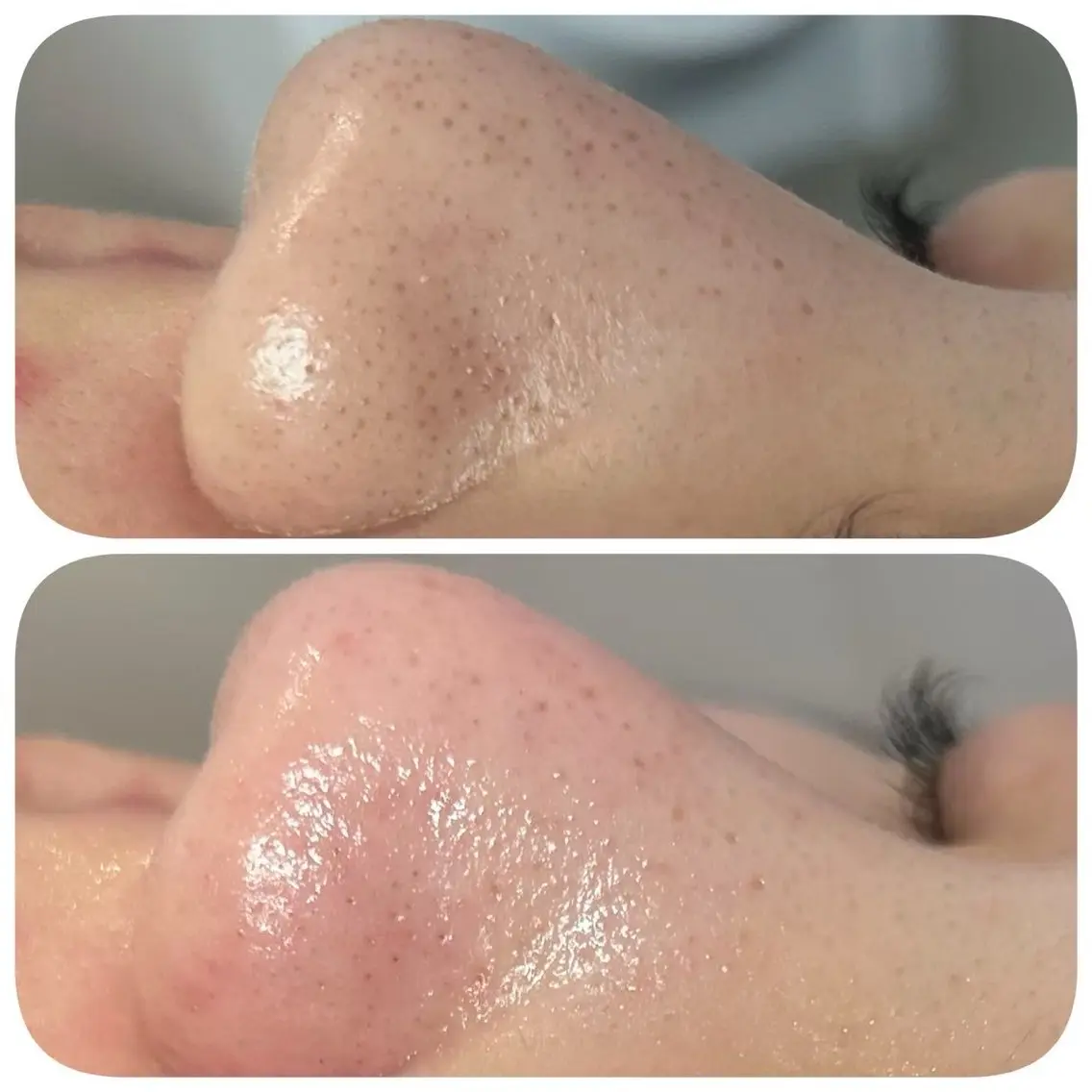 毛穴エクストラクション👃🏻✨の写真