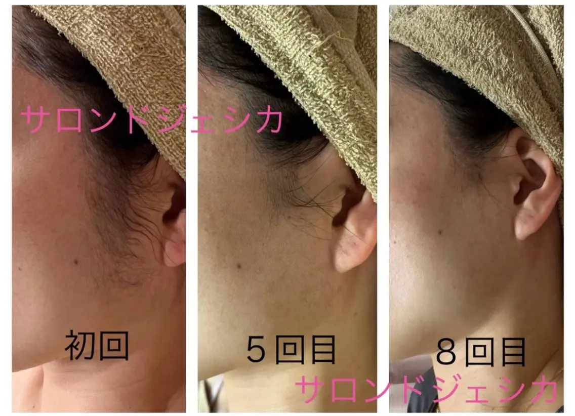 【都度払い可】 脱毛 サロンドジェシカのエステ・リラクイメージ