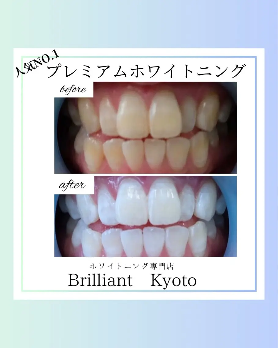 【ミニモ限定クーポン】医療プレミアムホワイトニング / 本来の歯よりも白くなりたい方に🦷✨の写真