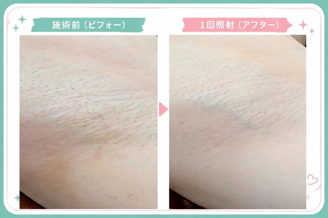 【新規の方】レディース・メンズ両ワキ脱毛¥4,000→¥2,000の写真