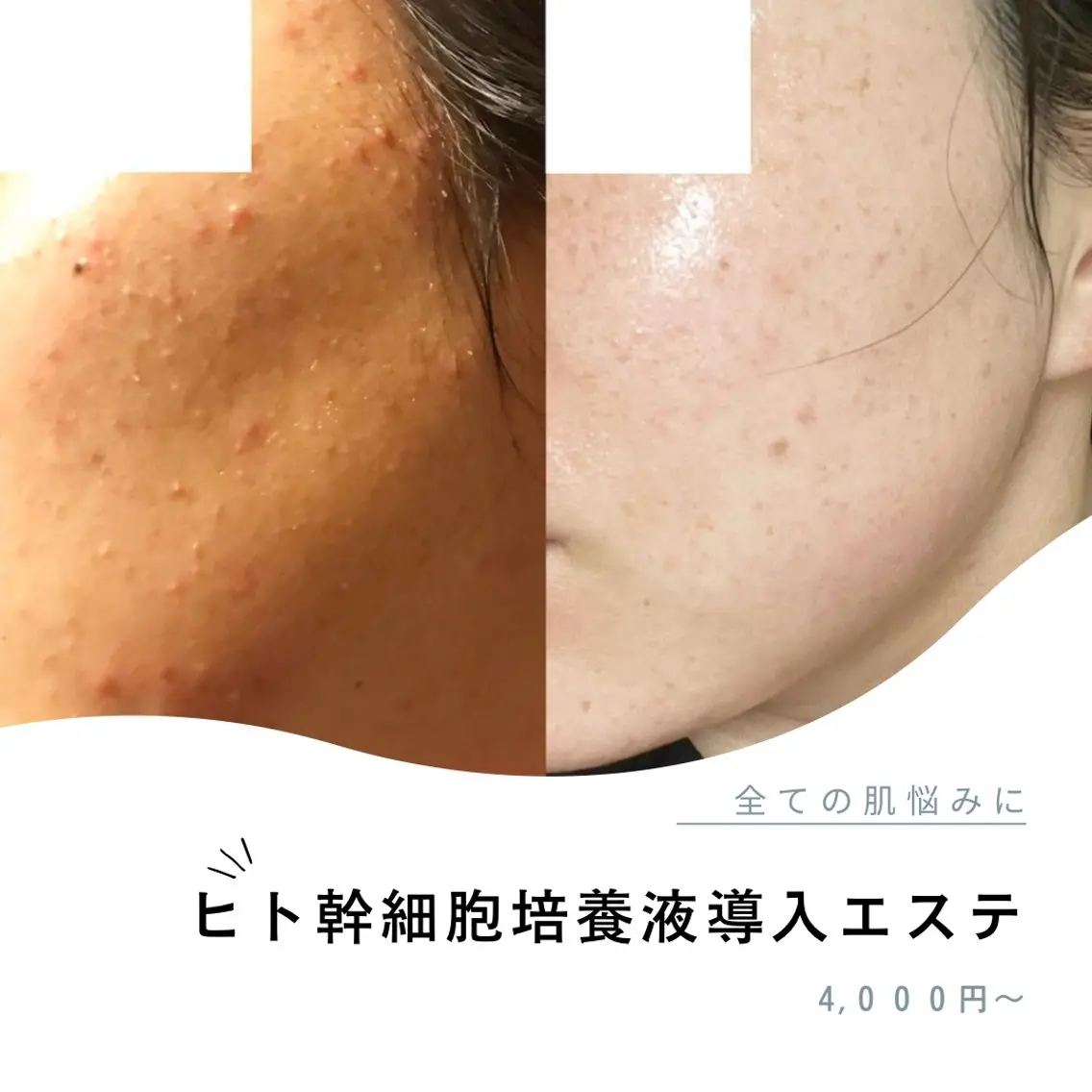 ニキビ肌、毛穴でお悩みの方🌱目指せつやつや美肌✨ヒト幹細胞エステの写真