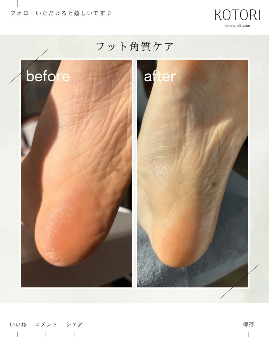 【足裏角質ケア・フットバス付き！】古く硬くなった足裏の角質をケアの写真
