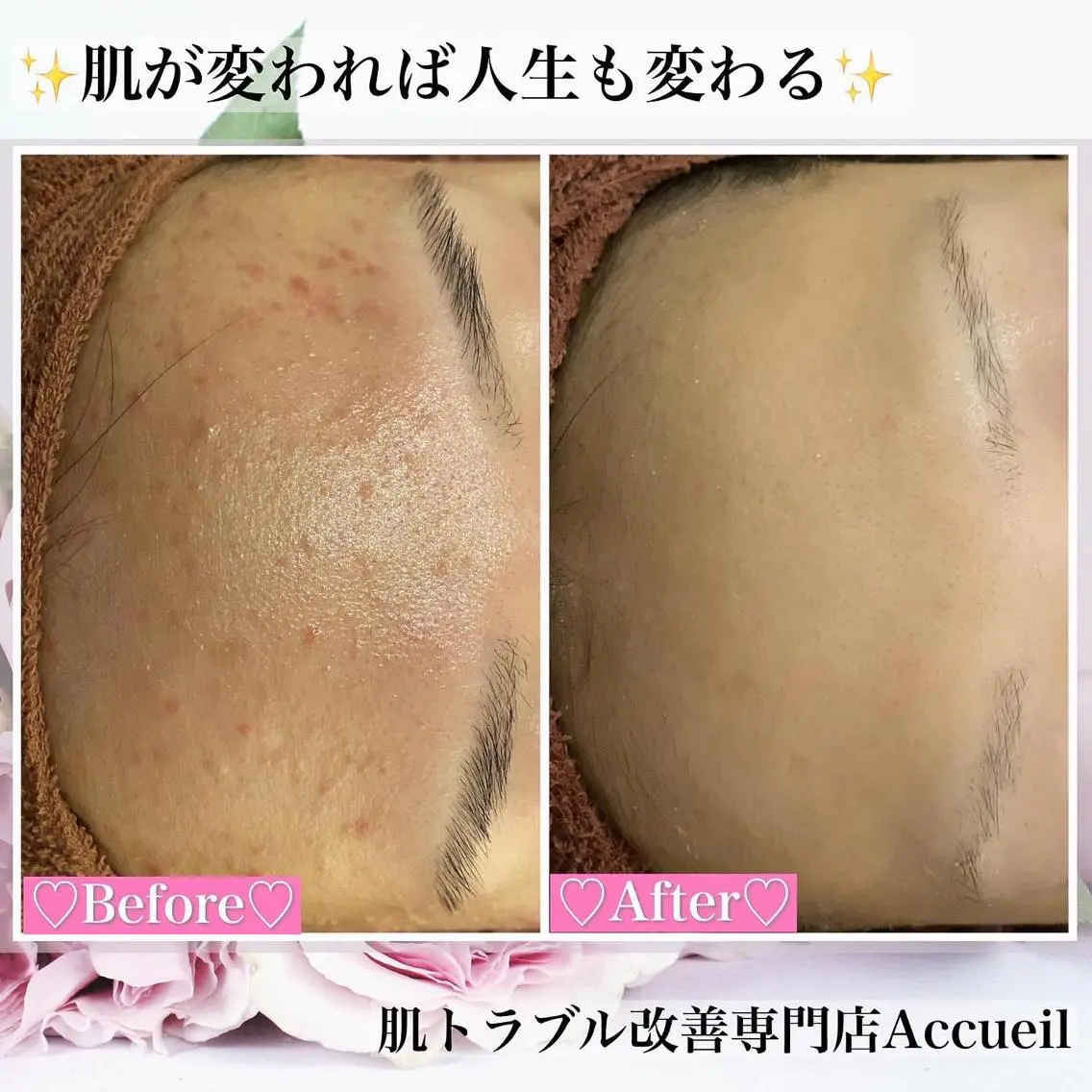 ミディアム カラー パーマ ヘアアレンジ メンズ キッズ ネイル マツエク・マツパ アイブロウ エステ リラク ニキビ・肌質改善専門 ♡人生が変わるサロンのエステ・リラクイメージ