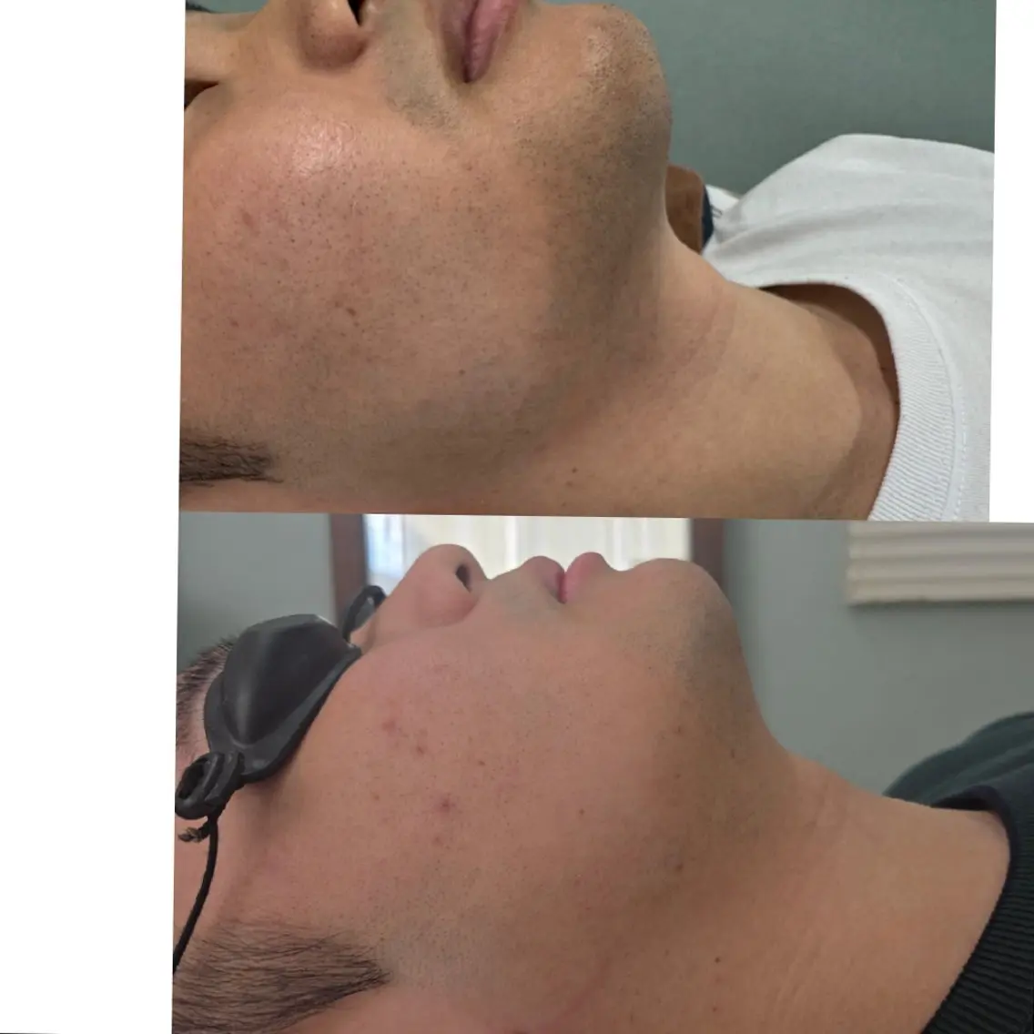 男性必見!お髭脱毛✨️の写真