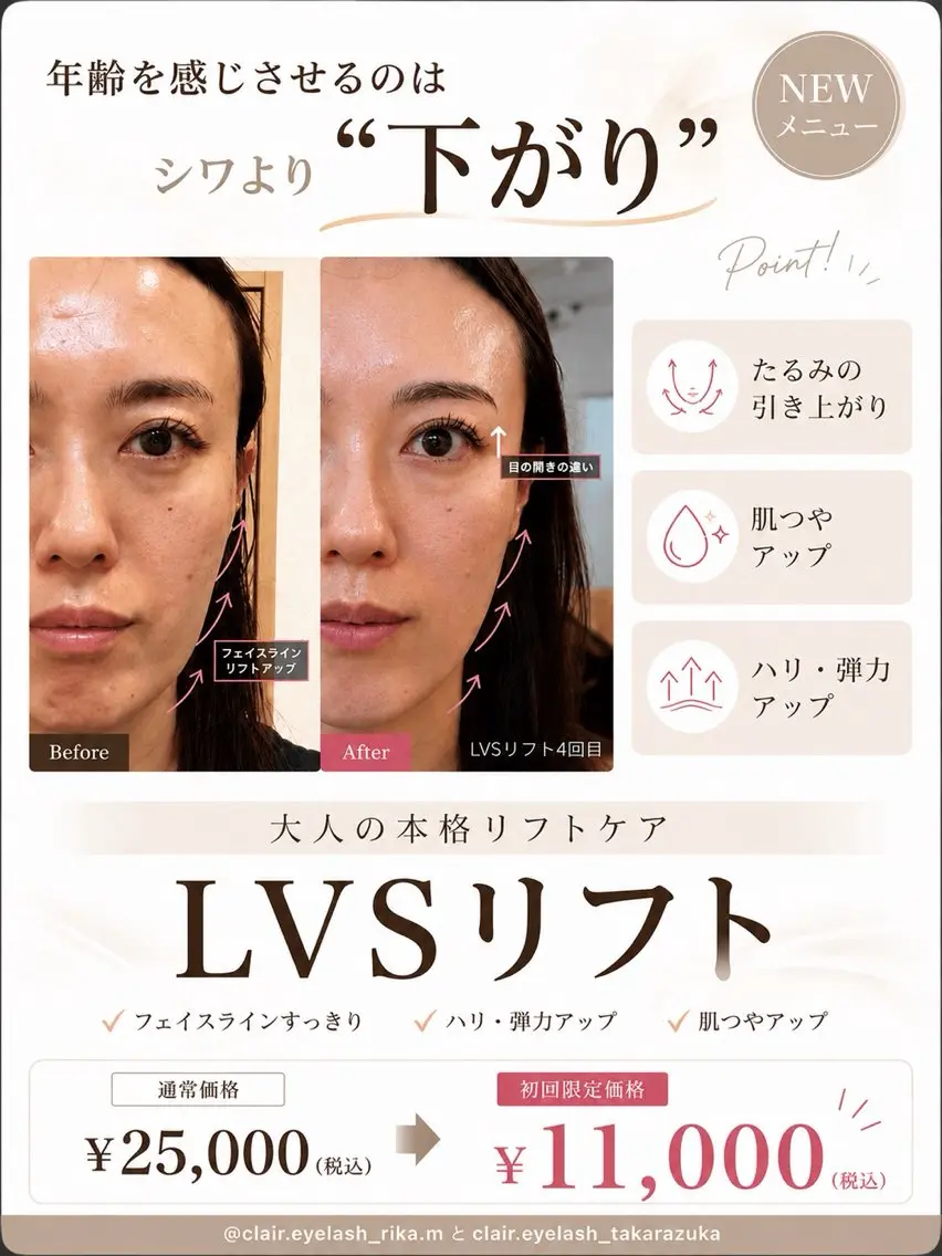 【たるみ・肌質改善】切らないリフトアップ「LVSリフト」60分の写真