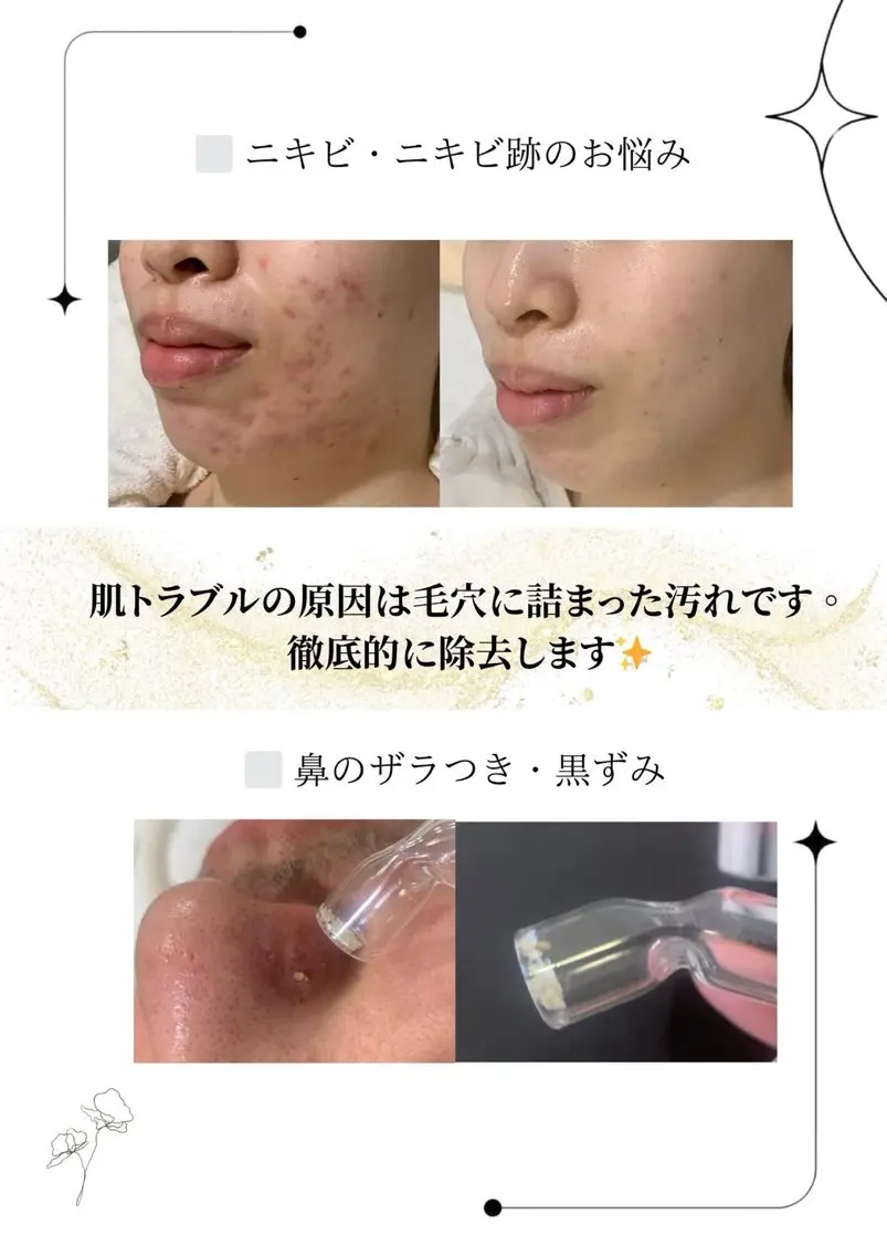 メンズ 肌質改善🫧 みゆのエステ・リラクイメージ