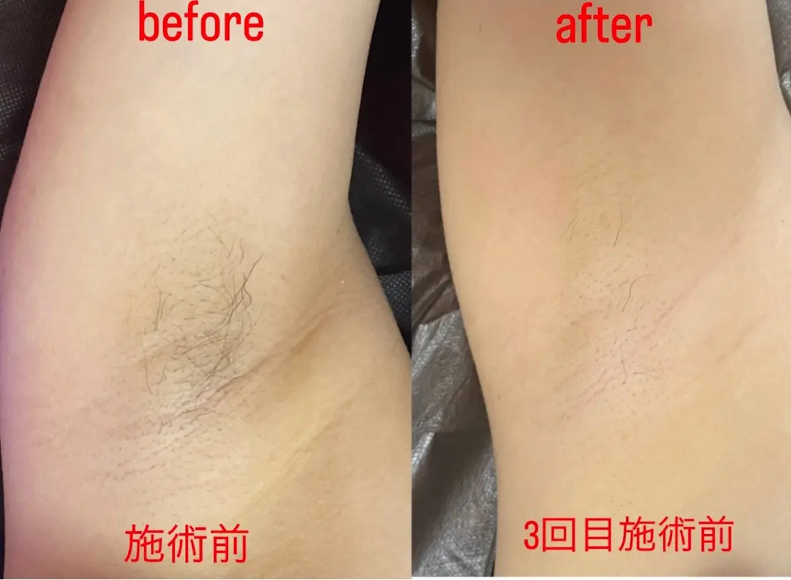 【剃り忘れ/黒ずみバイバイ👋】ワキ美肌脱毛☆もう自己処理終わりにしよう♪の写真