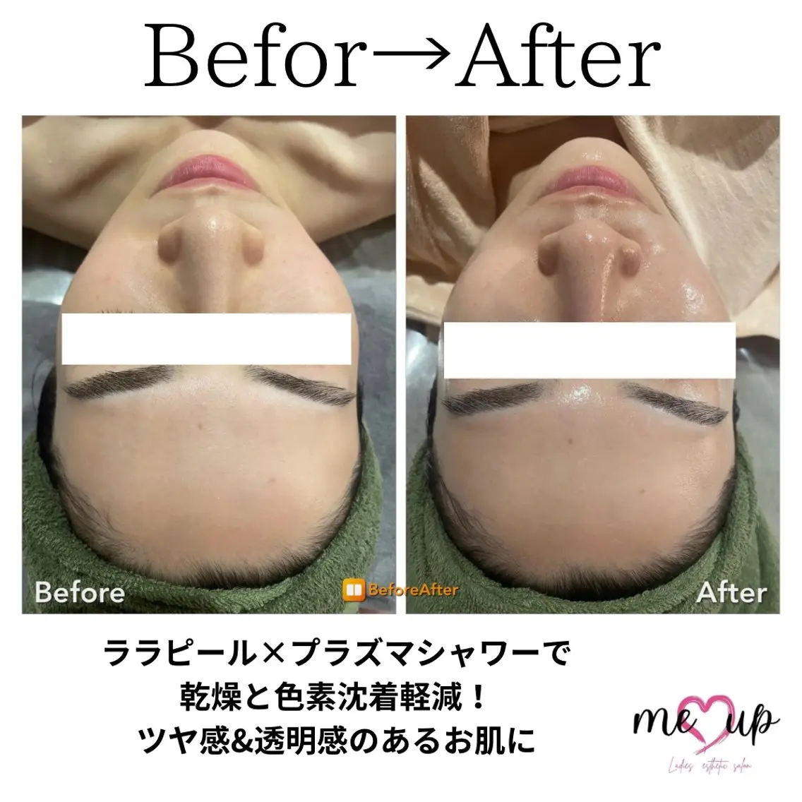 エステ Meupニキビ専門店 背中/ハーブ/肌管理のその他イメージ