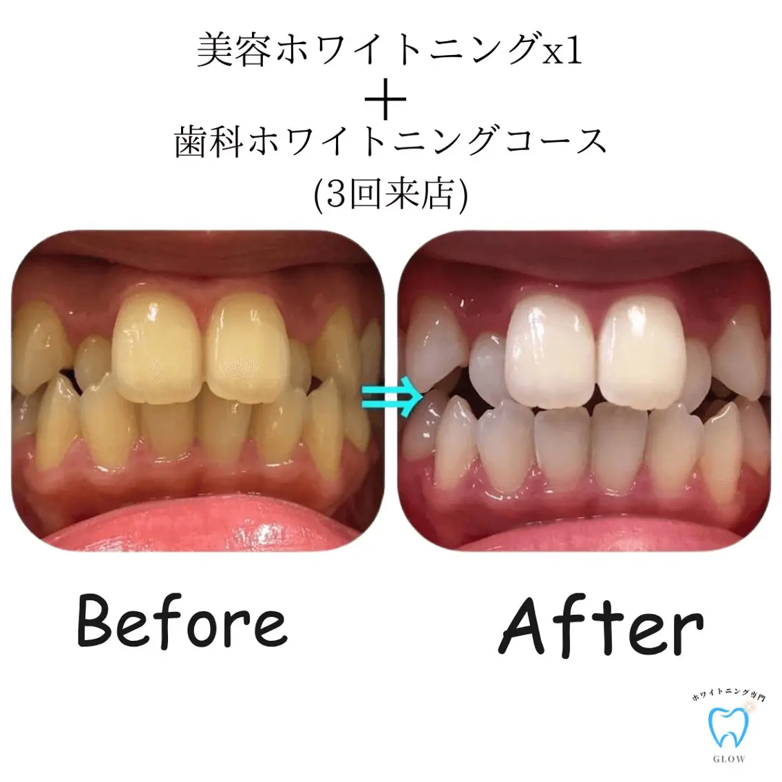 ホワイトニングモニター募集⭐️撮影、口コミ、メンションに協力いただける方！内容に応じて割引の写真