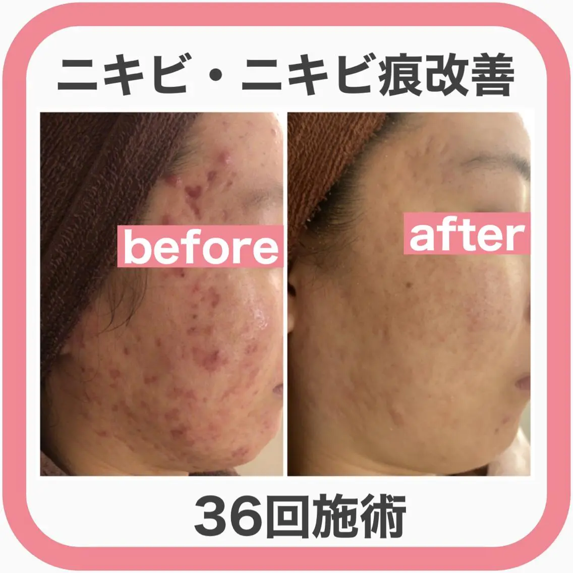 ミディアム カラー パーマ ヘアアレンジ メンズ キッズ ネイル マツエク・マツパ エステ リラク ニキビ・肌質改善専門 ♡人生が変わるサロンのエステ・リラクイメージ