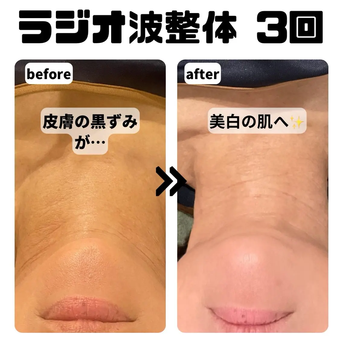 【初回限定35%OFF】 ラジオ波小顔矯正💆‍♀️たるみ/ゆがみ/むくみ/しわ/肌荒れ【小顔/デコルテ/首/頭】の写真