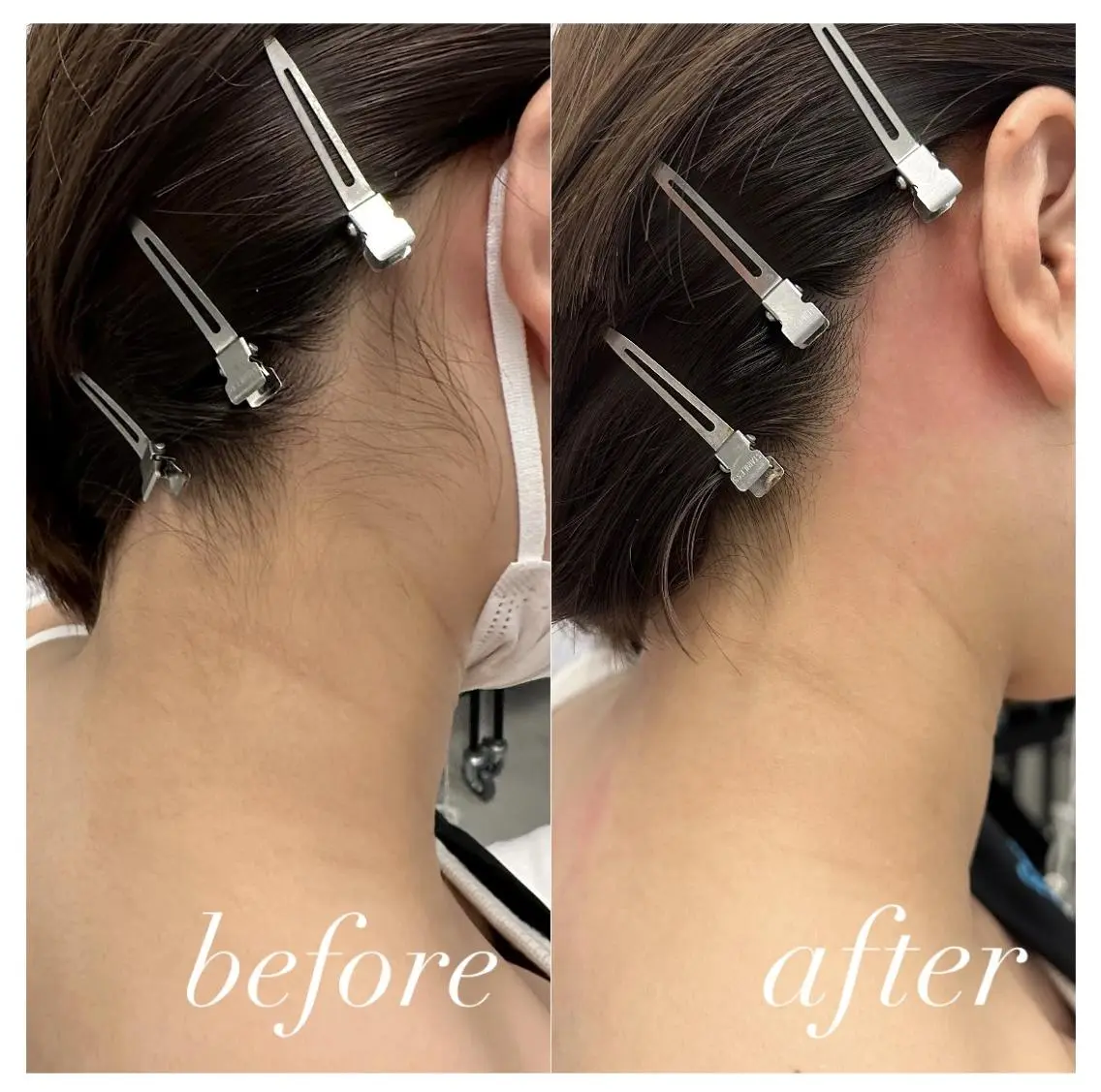 【うなじワックス脱毛】🤍ྀི角質も一緒にケアしてツルスベ肌に✨トーンアップ効果🫧の写真