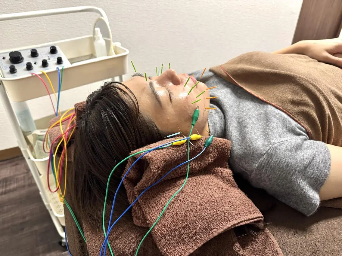 ⭐️おすすめNo.2⭐️【リフトアップメニュー特化】W電気美容鍼+ヘッドマッサージ+首肩背中マッサージの写真