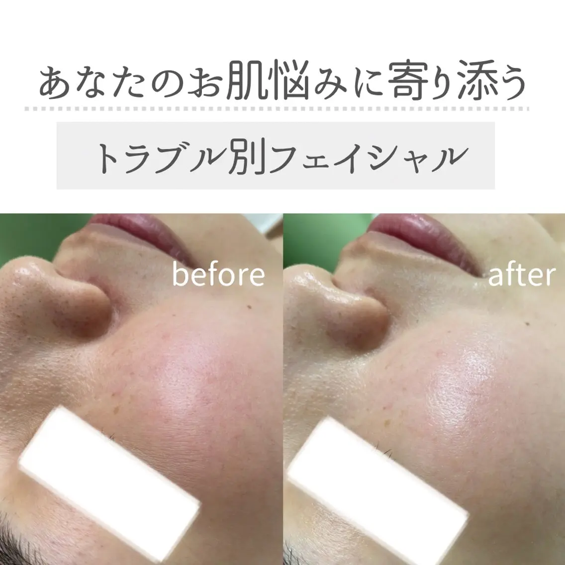 minimo初回限定【ﾄﾗﾌﾞﾙ別ﾌｪｲｼｬﾙ🕊️】の写真