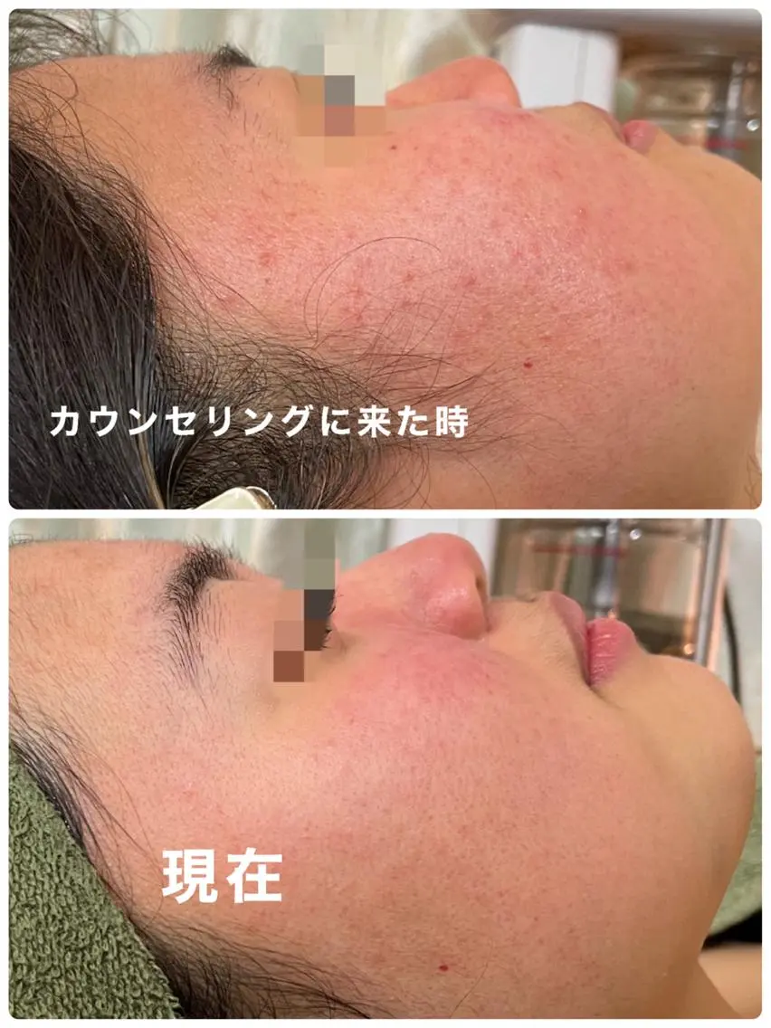 グリーンピール5daysモニター募集の写真