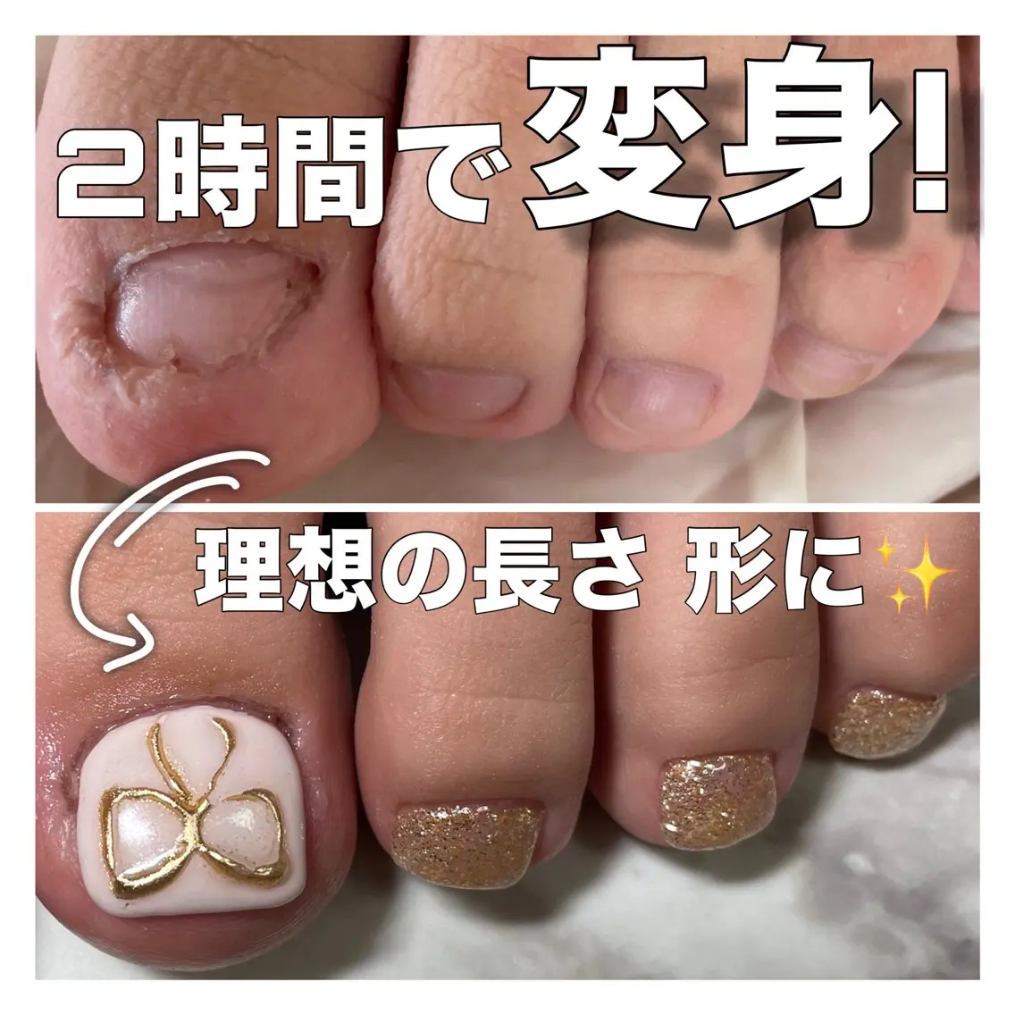 フット深爪矯正【長さ出し】◆アート×2◆(オフ込/フットバス付) むしったり 割れたり 小さくなった爪も綺麗な状態に✧︎の写真