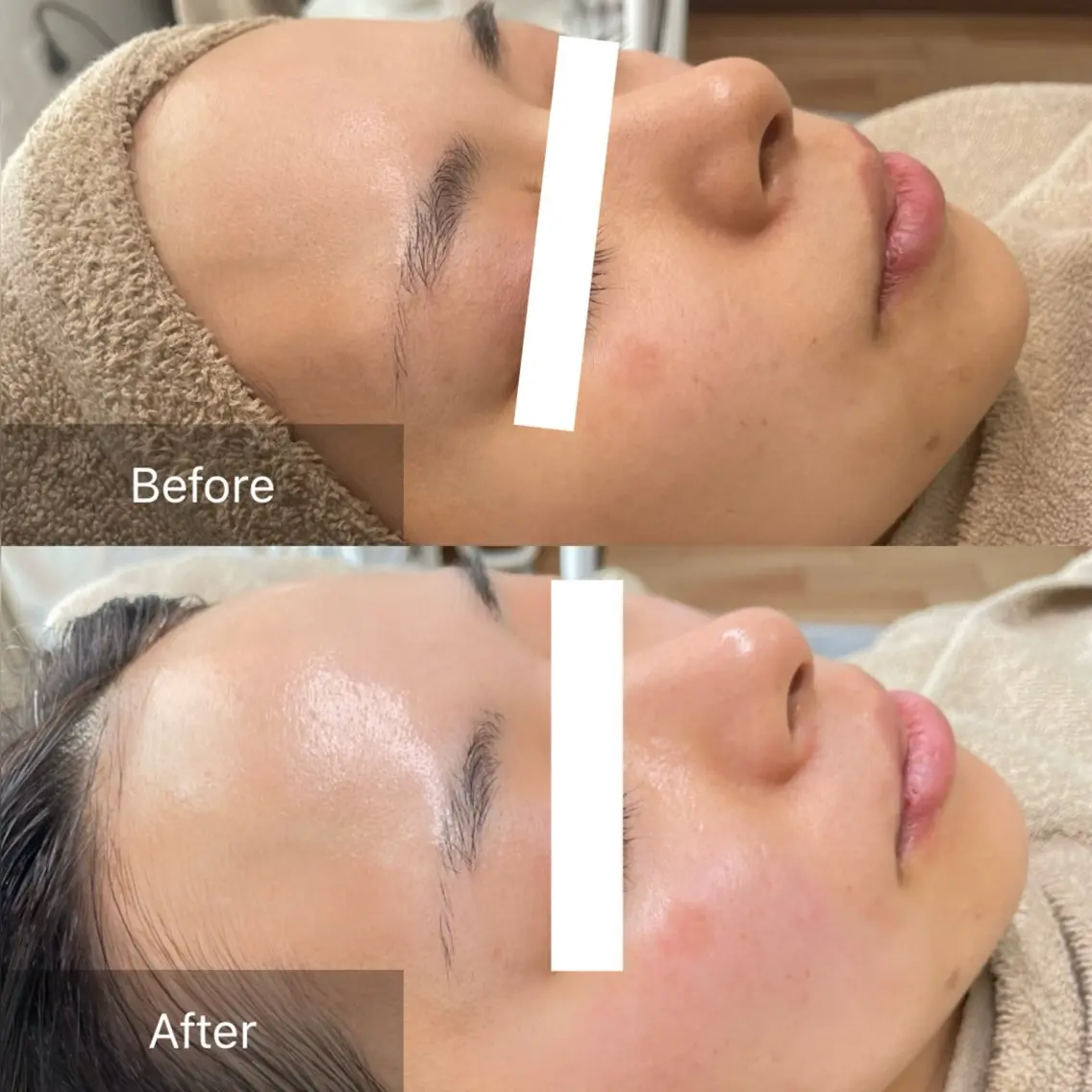 【ワックス顔脱毛が不安な方へ】おでこor鼻orアゴ⭐︎お試しメニュー⭐︎フェイスワックストリートメントの写真