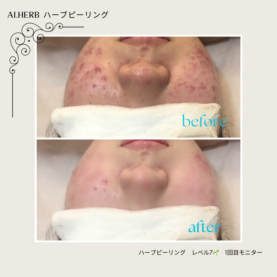 メンズ ハーブピーリング専門 店⭐︎AI.HERBのエステ・リラクイメージ