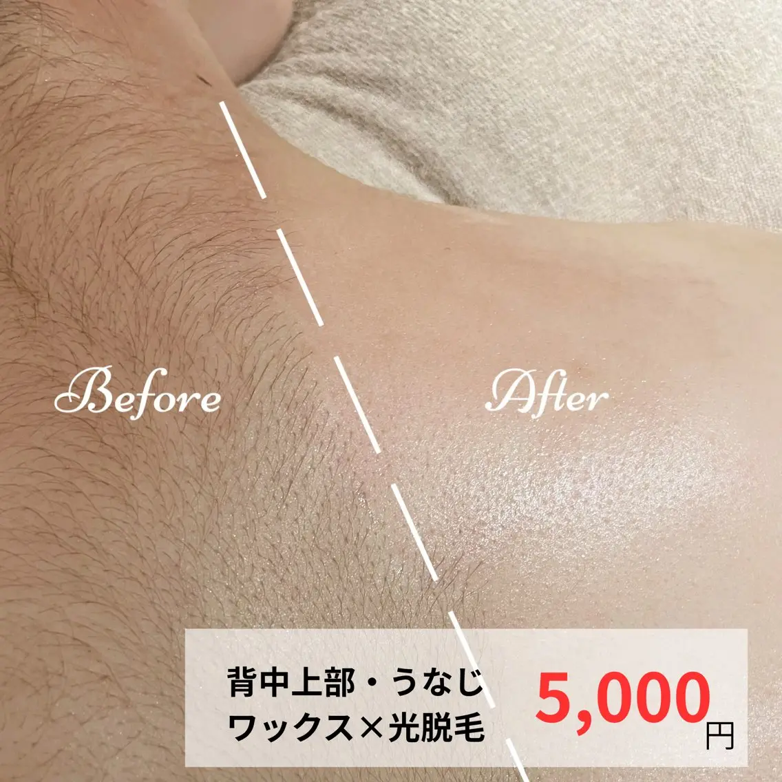 背中上部・うなじWAX＋光脱毛 ¥5,000の写真