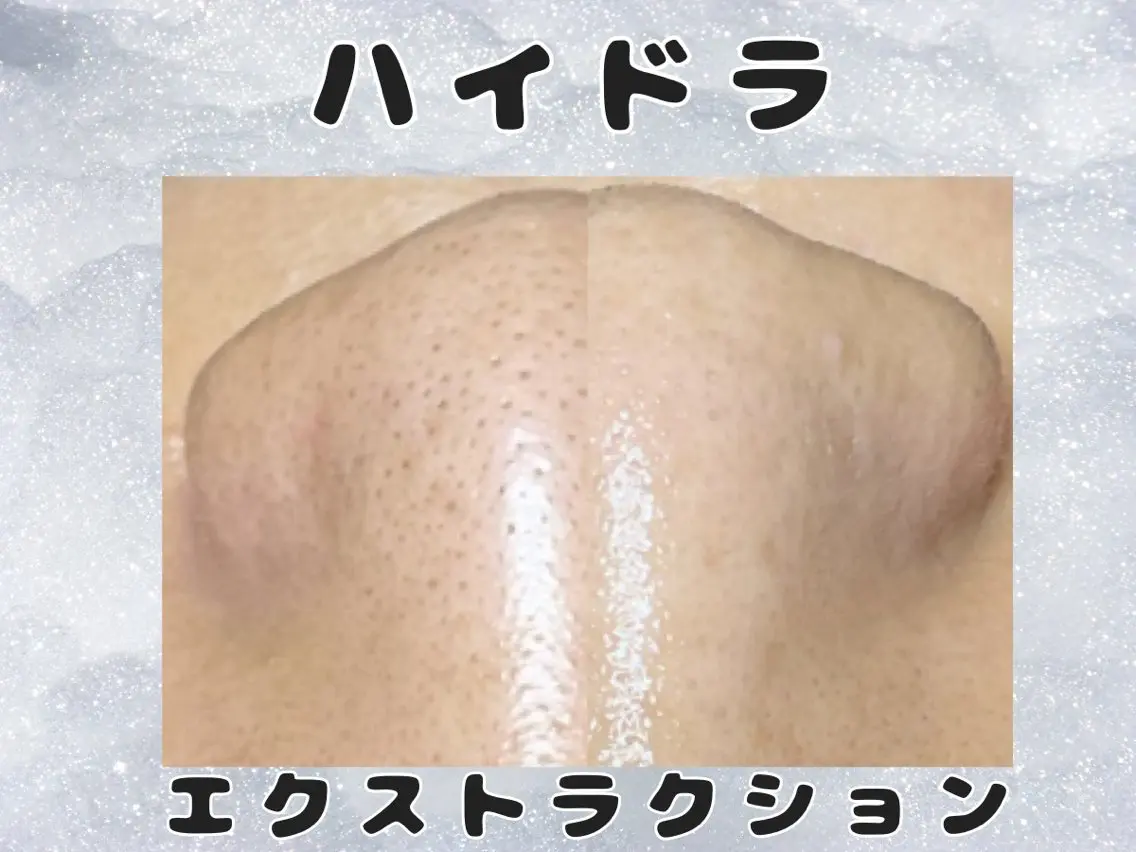 ハイドラ×毛穴エクストラクション★水光肌リフティング付きの写真