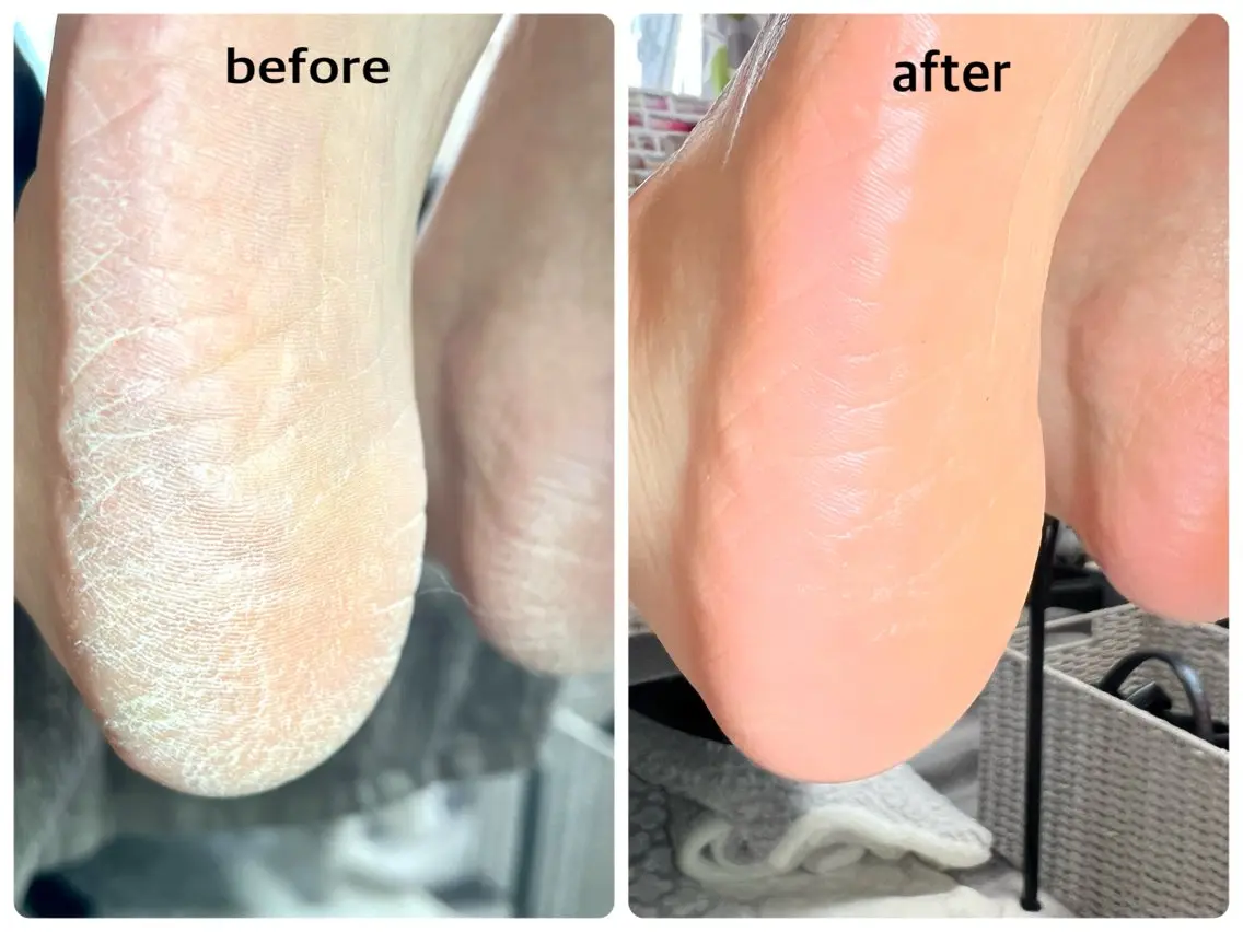 ツルふわ✨フット角質ケアの写真