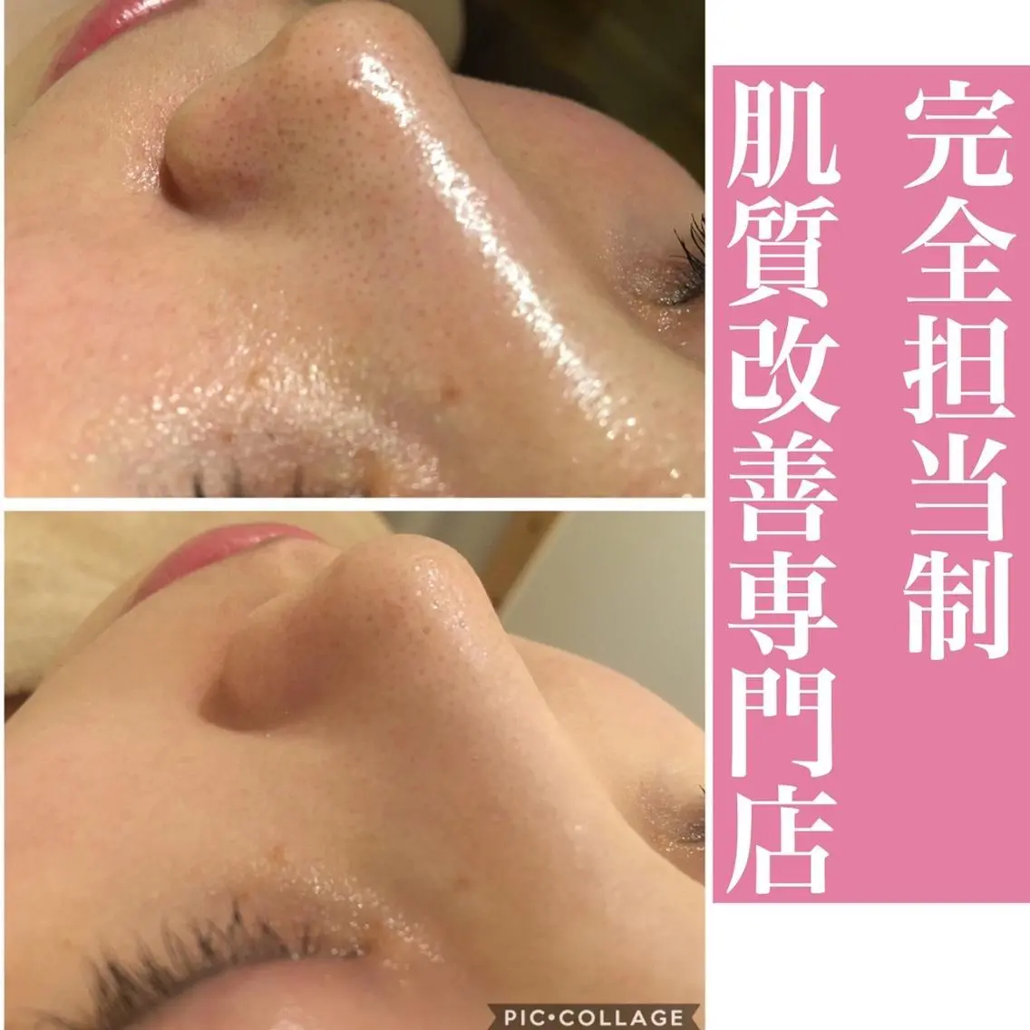 3か月で肌革命👼 ニキビ専門店💫のエステ・リラクイメージ