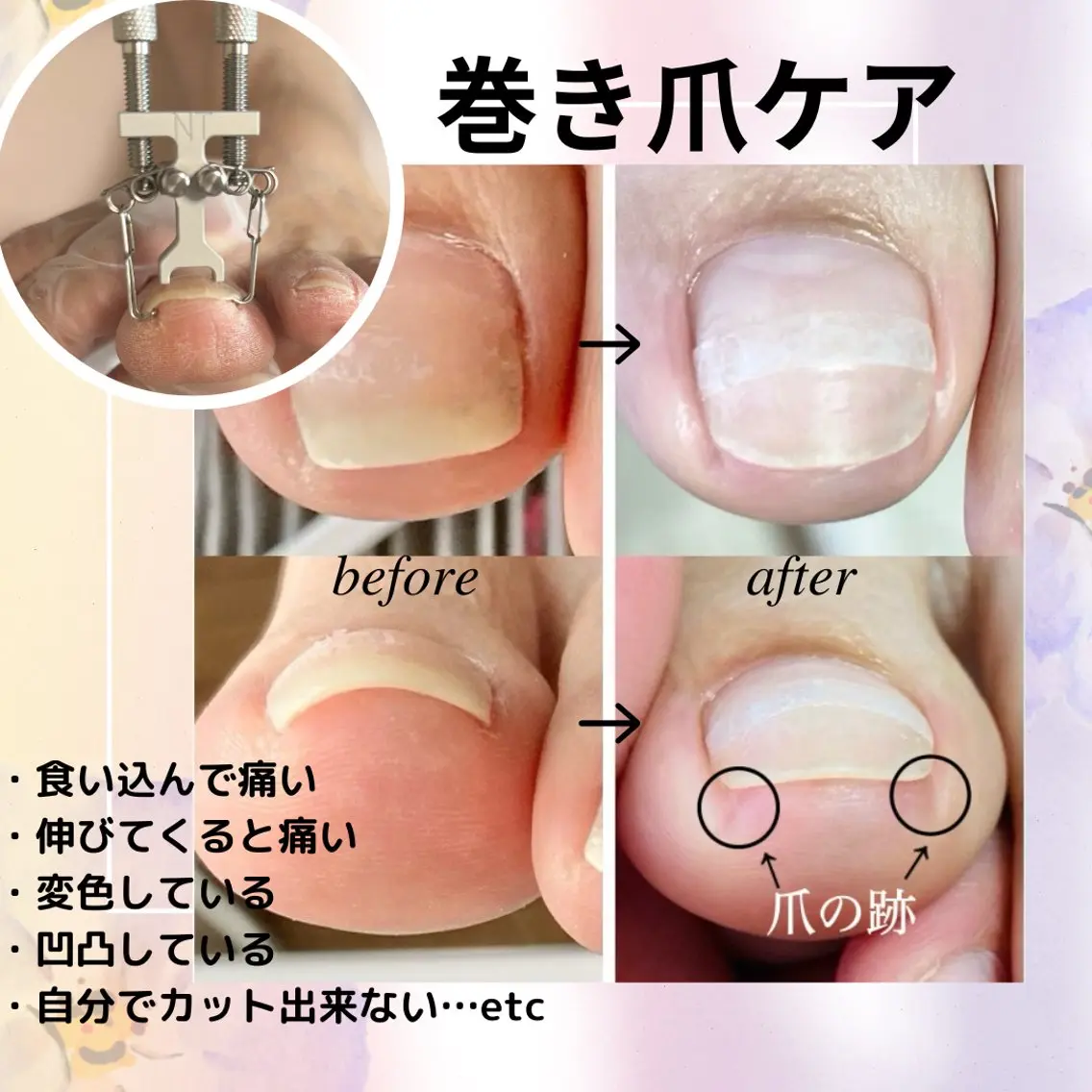 5名様限定✨巻き爪ケアモニター(ケア＋牽引＋チップ装着)親指1本の写真
