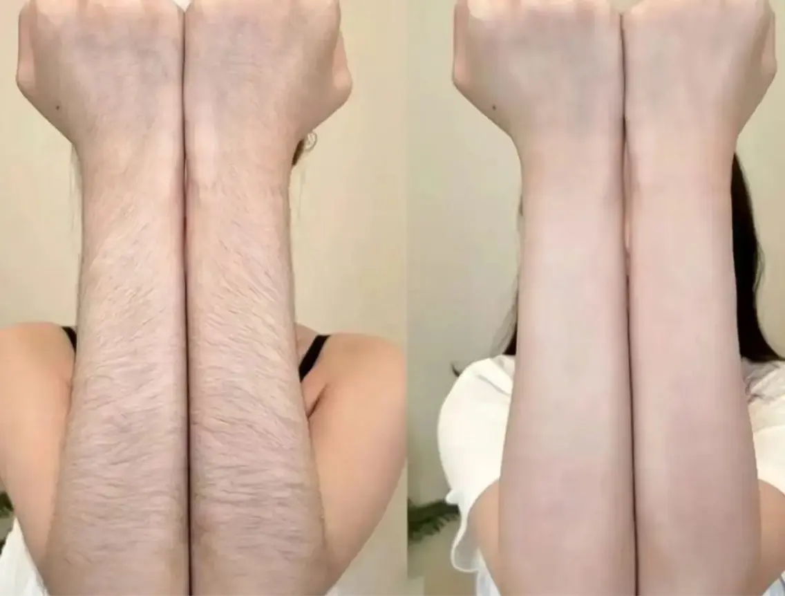 両腕脱毛の写真