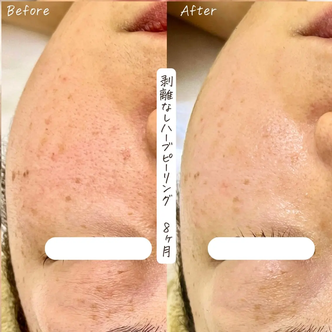 肌質改善サロン renew/ウエキのエステ・リラクイメージ