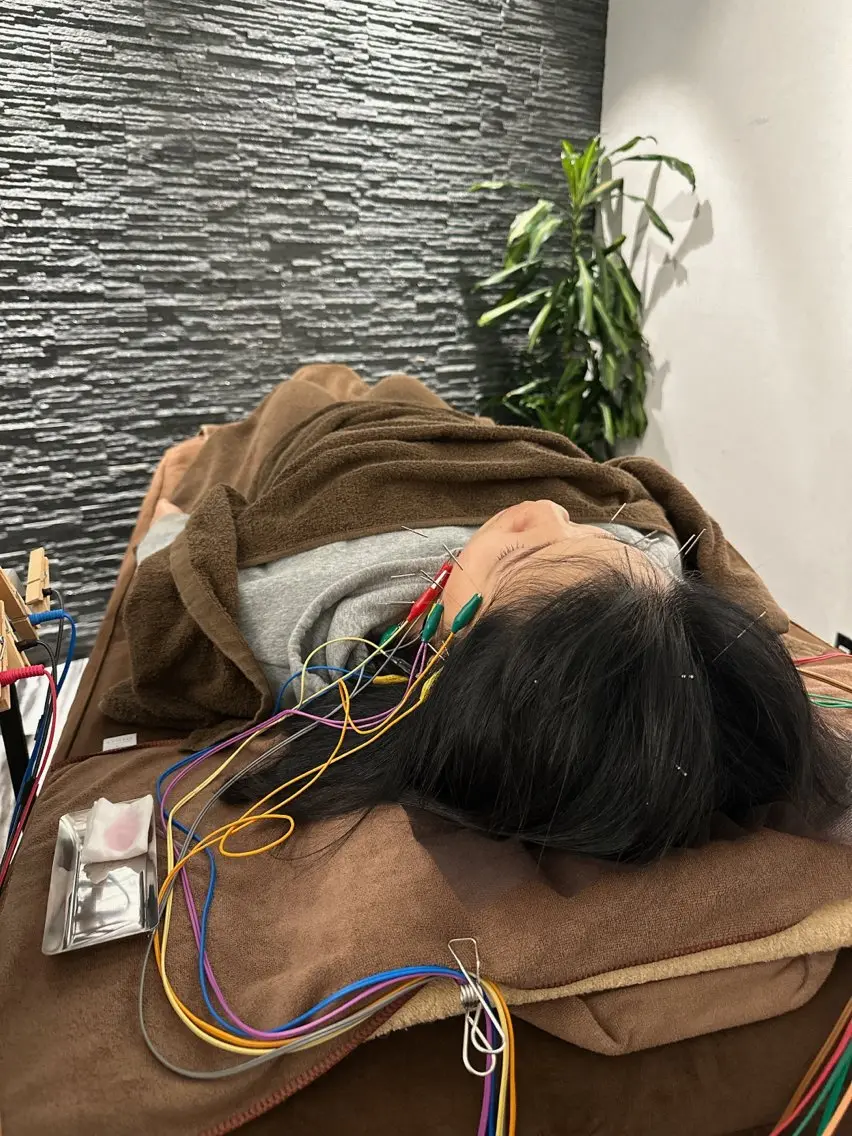 その他 小顔矯/美容鍼/鍼灸 BeauJuのその他イメージ