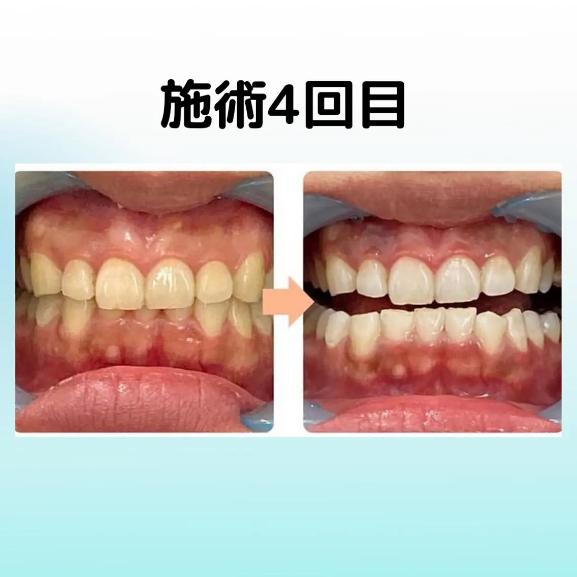 その他 ホワイトニング シャトンのその他イメージ