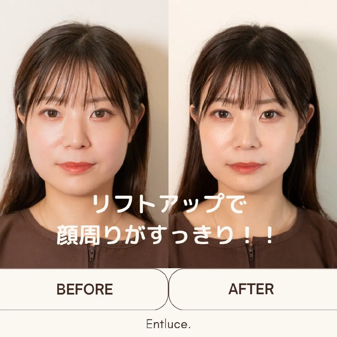 エステ リラク 即効⚡小顔美容鍼🪡 むくみたるみ脂肪解消のエステ・リラクイメージ
