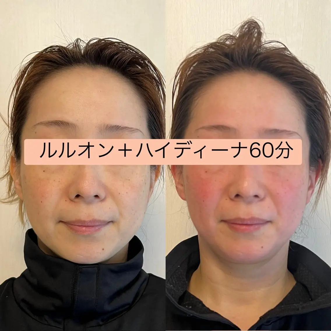 【2回目限定】人気急上昇!全身水素まみれコース¥10800の写真