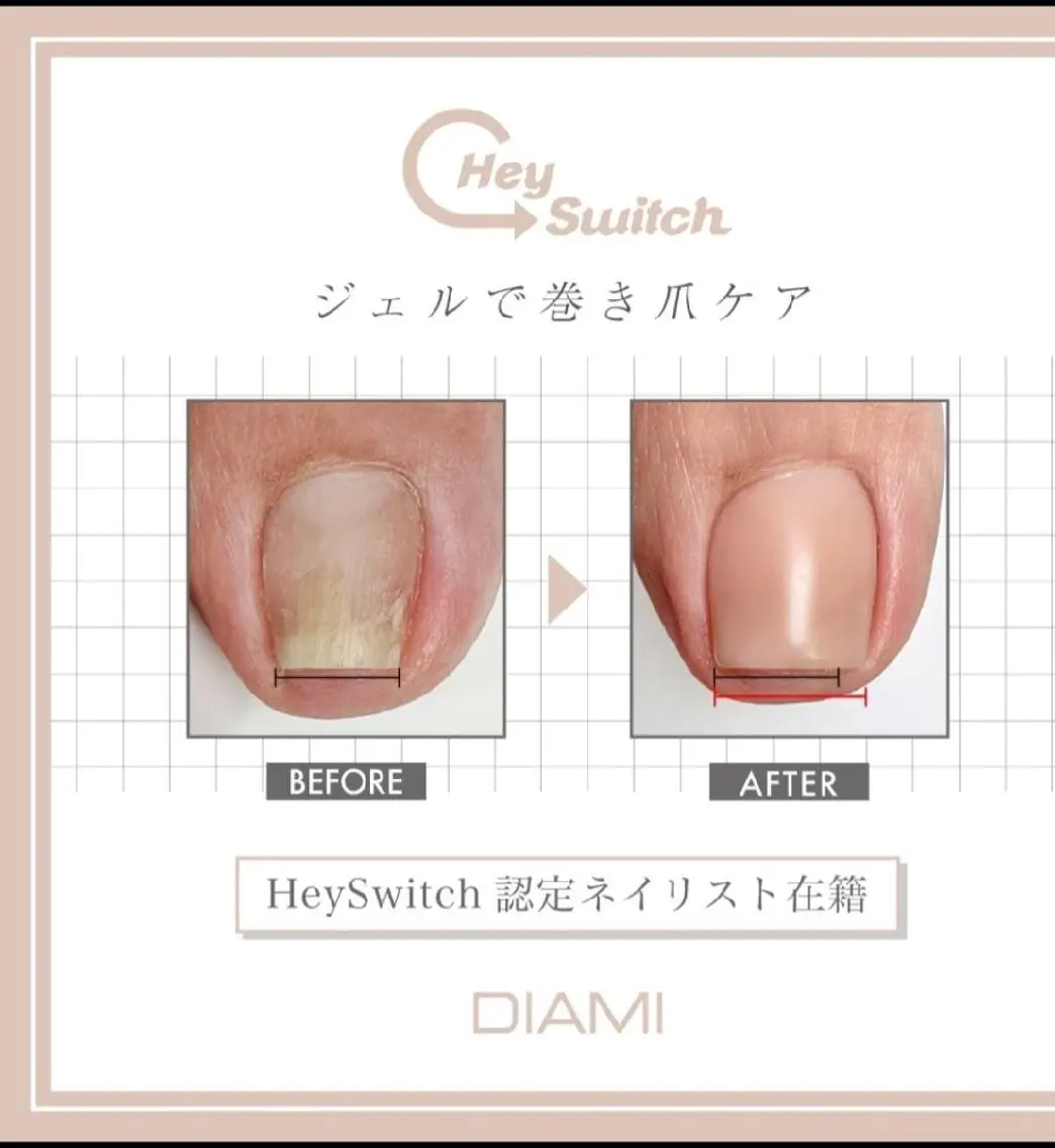 👣フット専用👣　巻き爪ケアの写真